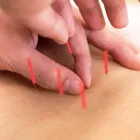 鍼灸